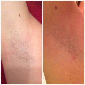 IPL Laser Hair Removal - before/after